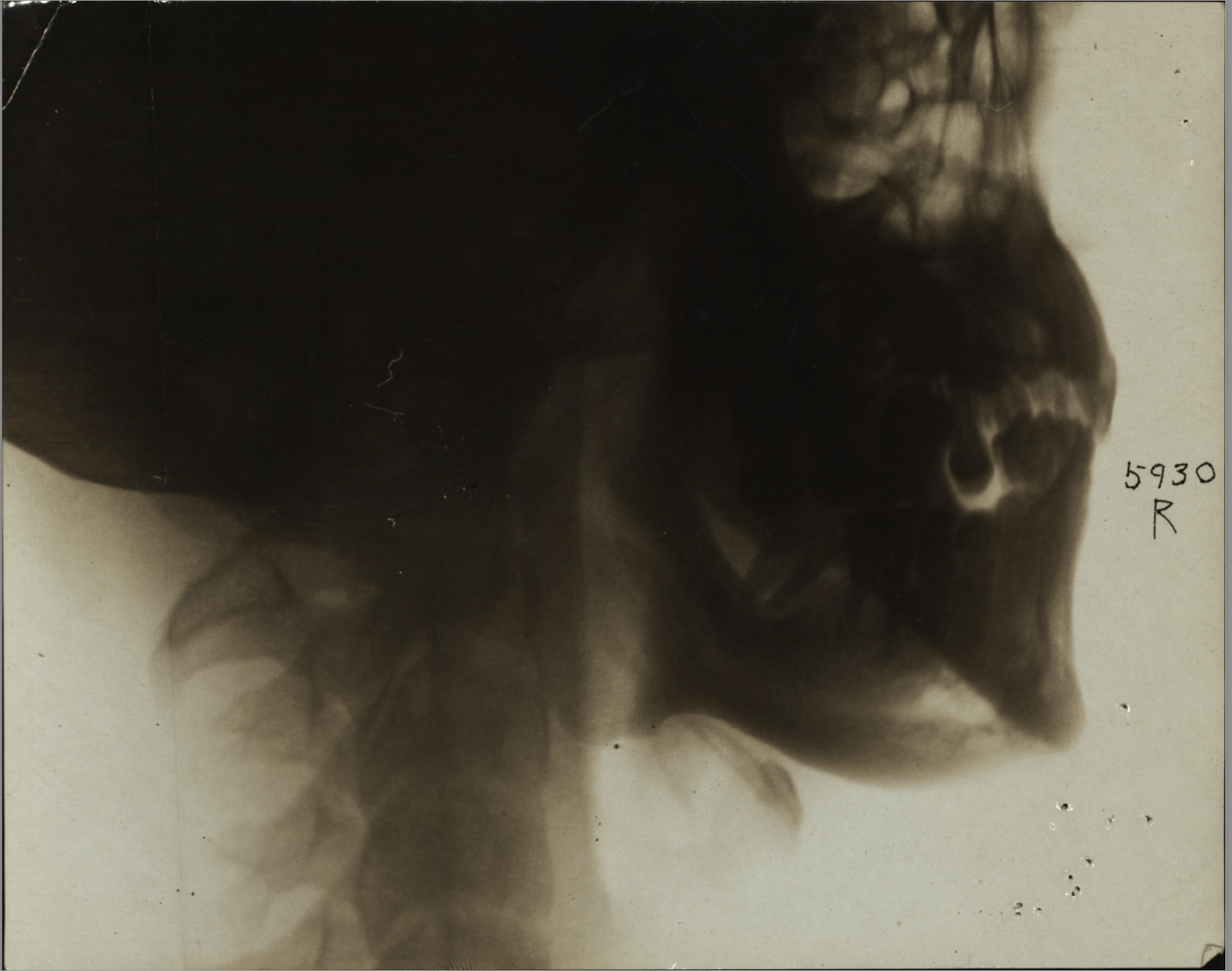 X-Ray of Skull showing broken jaw